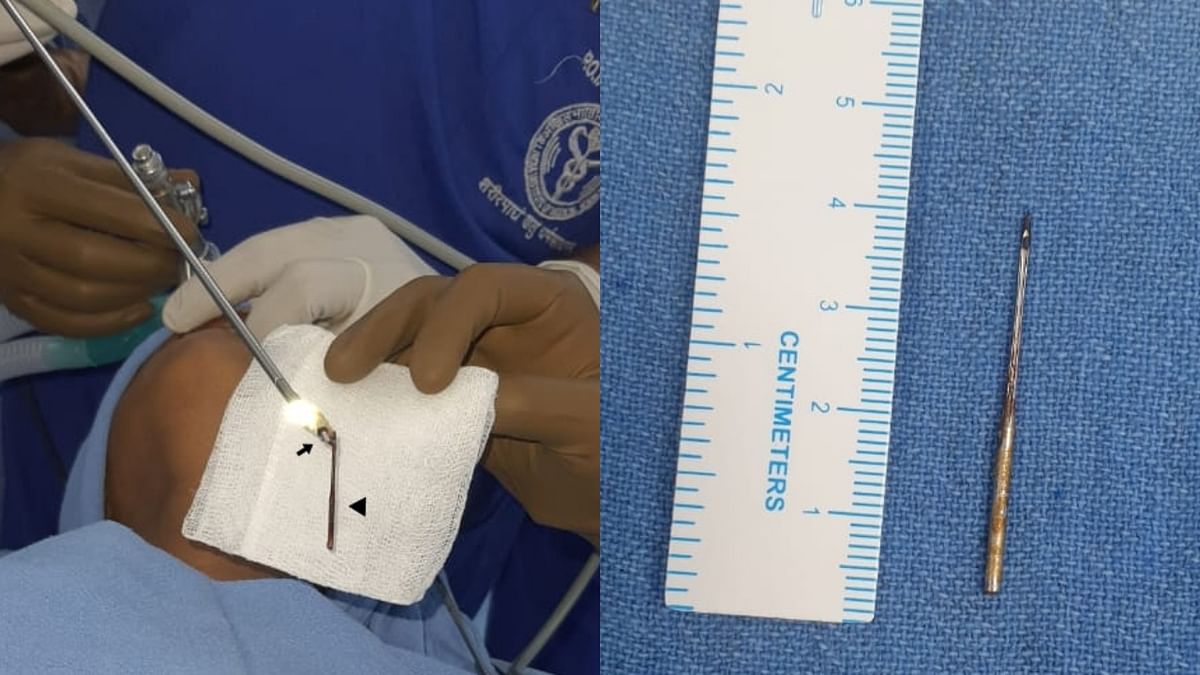AIIMS Delhi surgeons extract sewing needle from 7-year-old's lung using a magnet