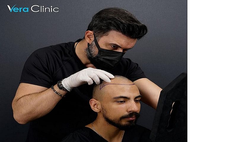 Best Hair Transplant Turkey at Vera Clinic: Techniques, Eligibility, and Outcomes