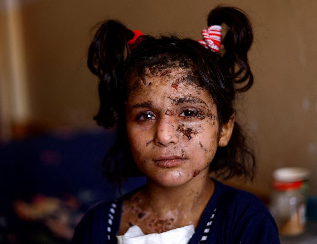 Palestinian girl Yara Al-Ghandour, who was wounded in an Israeli strike along with her two siblings and mother, looks on as she receives treatment at Nasser hospital, in Khan Younis in the southern Gaza Strip August 6, 2024.