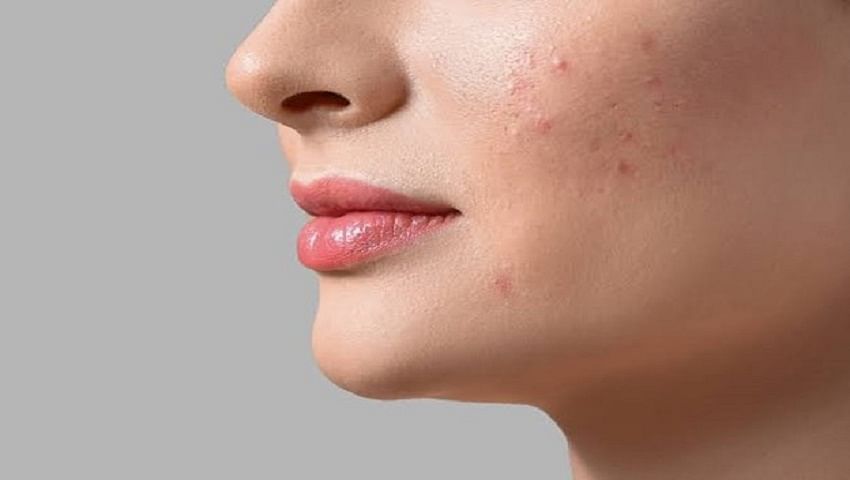 How to Reduce Acne?