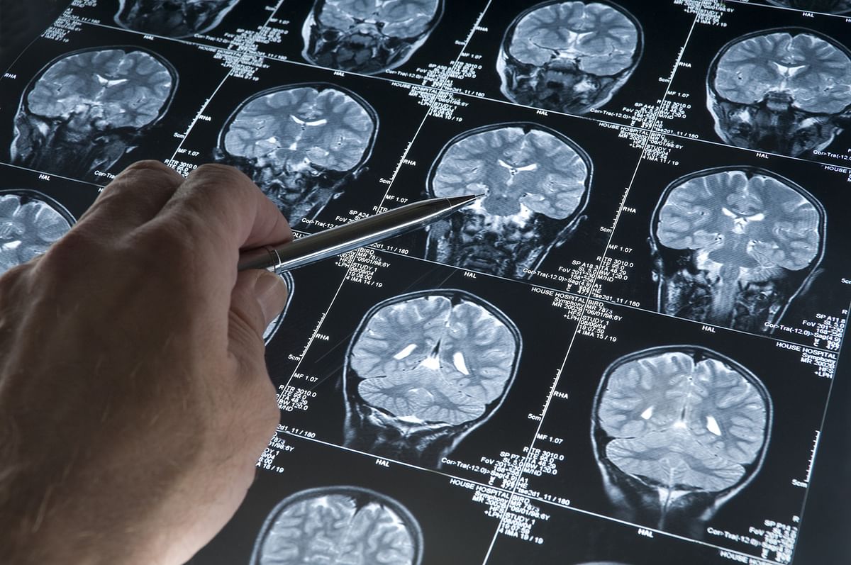 Image showing a brain scan. For representational purposes.