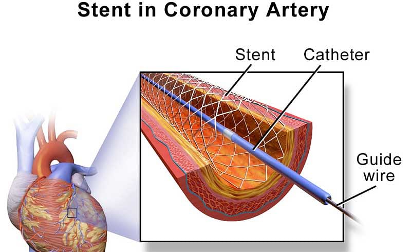 Indigenous coronary stents on par with US makes: Study