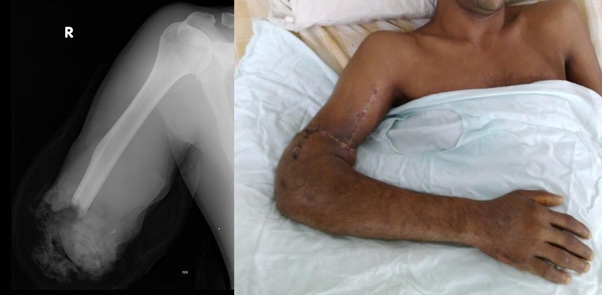 Kasturba Hospital doctors replant severed arm