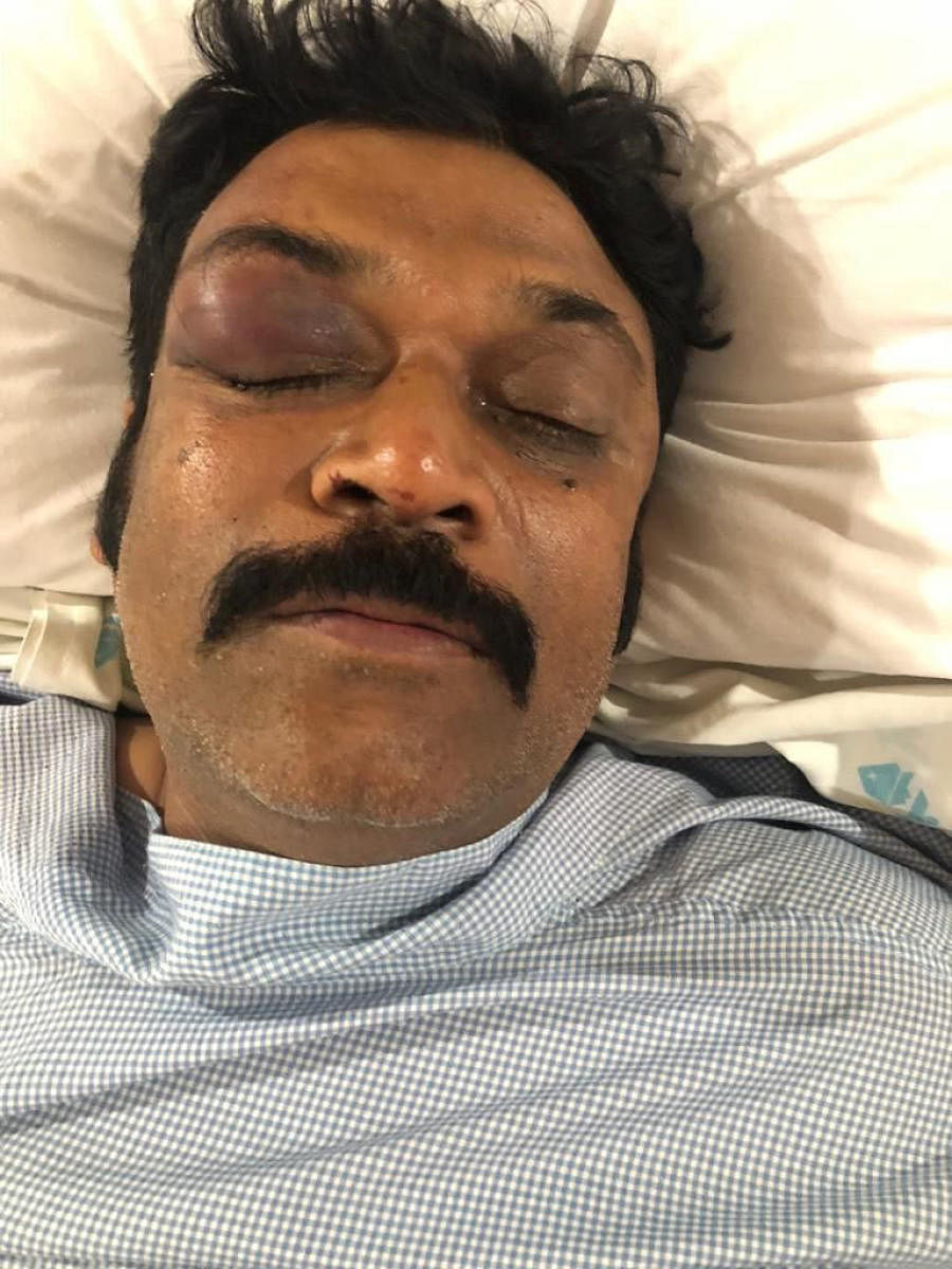 Bones around Anand Singh's eyes fractured
