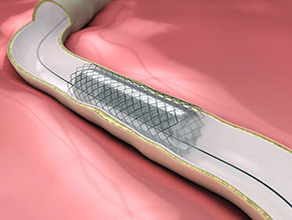 NPPA approves hike in prices of coronary stents