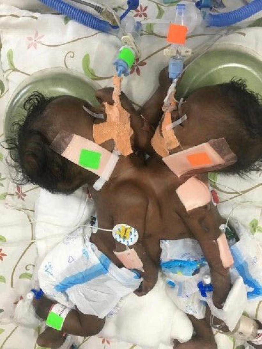 Life-saving surgery for conjoined Mauritian twins