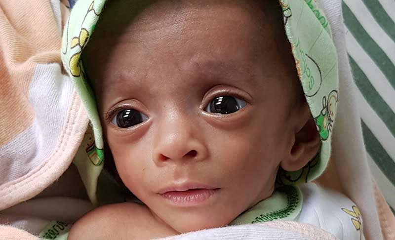 Tiniest baby in South Asia survives abdominal surgery