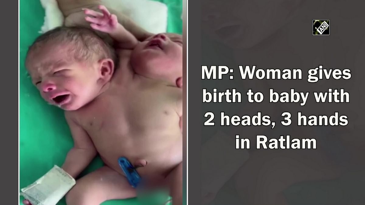 MP: Woman gives birth to baby with 2 heads, 3 hands in Ratlam