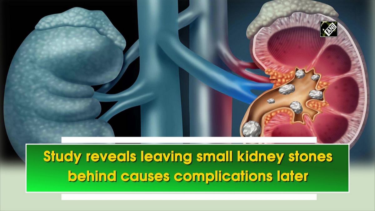 Study reveals leaving small kidney stones behind causes complications later