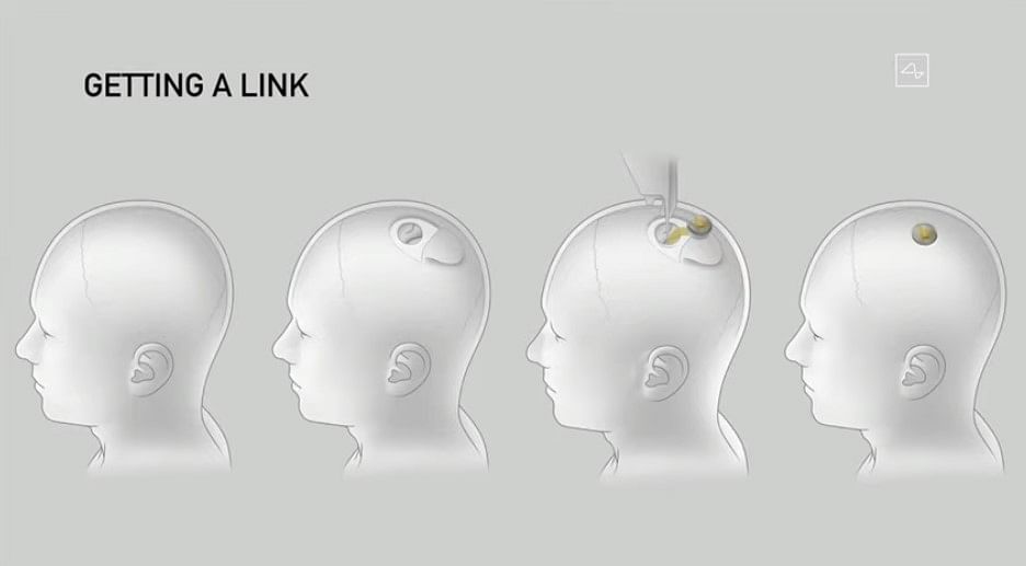 Transplanting of Neuralink device on a human skull. Credit: Neuralink/YouTube