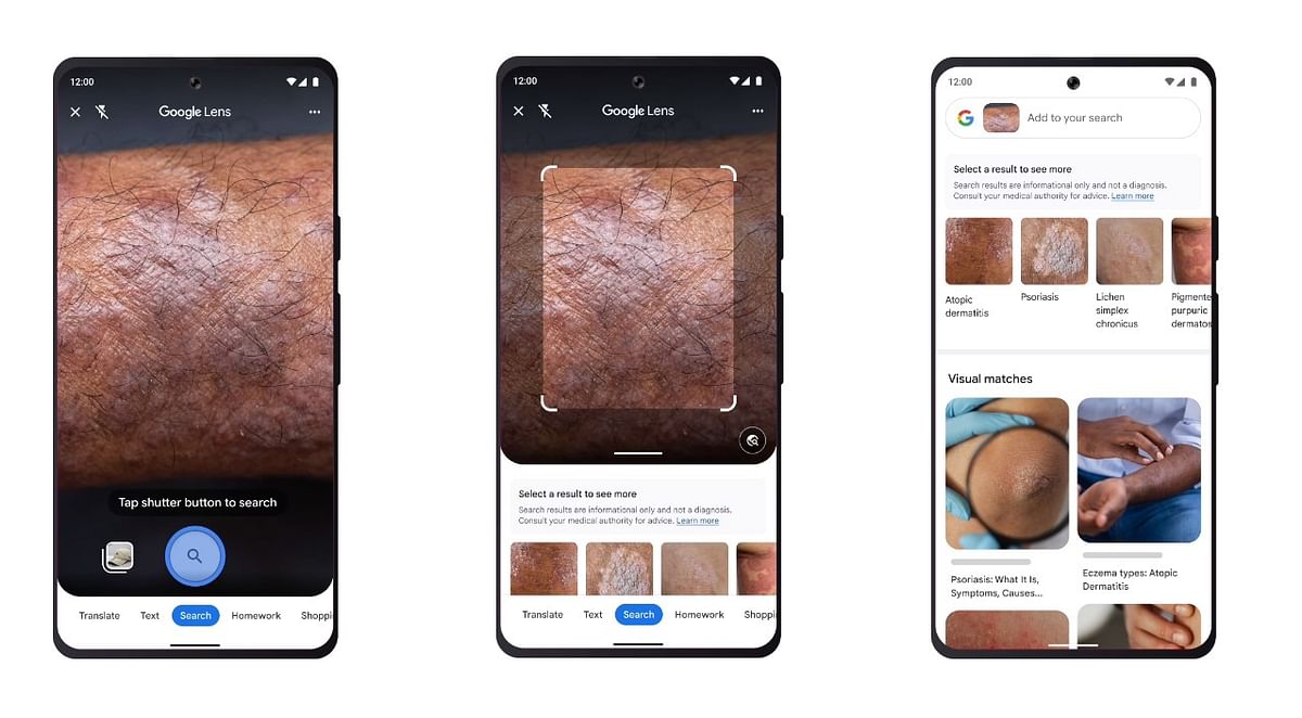 Google Lens feature gets skin condition detection feature. Credit: Google