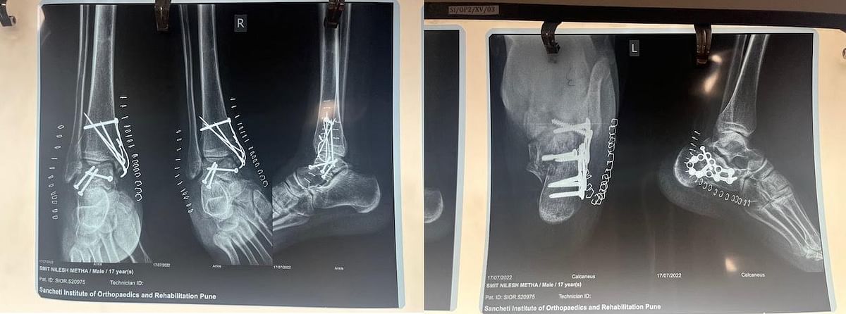 Smit Metha's X-Ray report. Picture Credit: Smit Metha