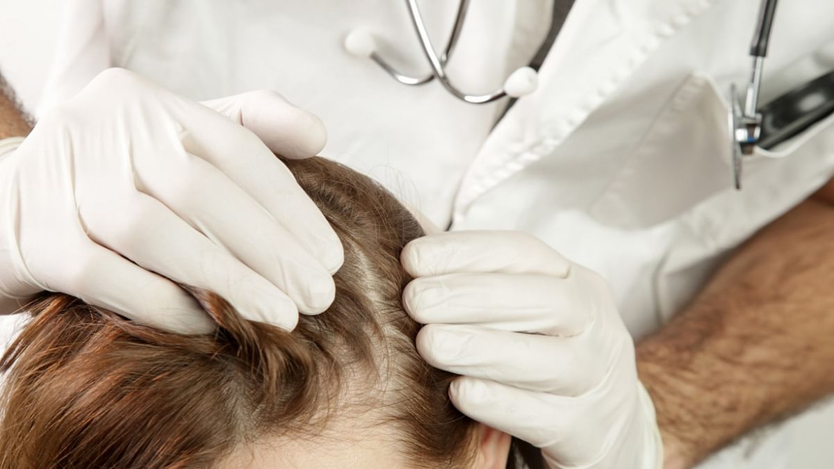 Hair loss complaints among Covid patients on rise at Delhi hospital
