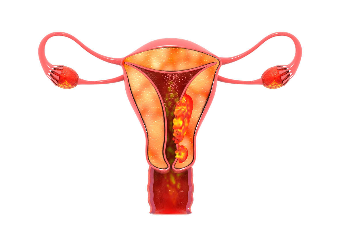 Dealing with the tissue of endometrial polyps