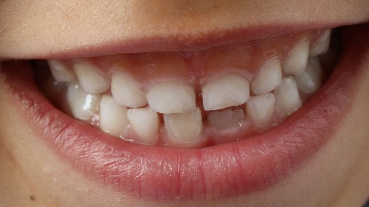 30 teeth removed from 10-year-old Indore boy with 50 teeth
