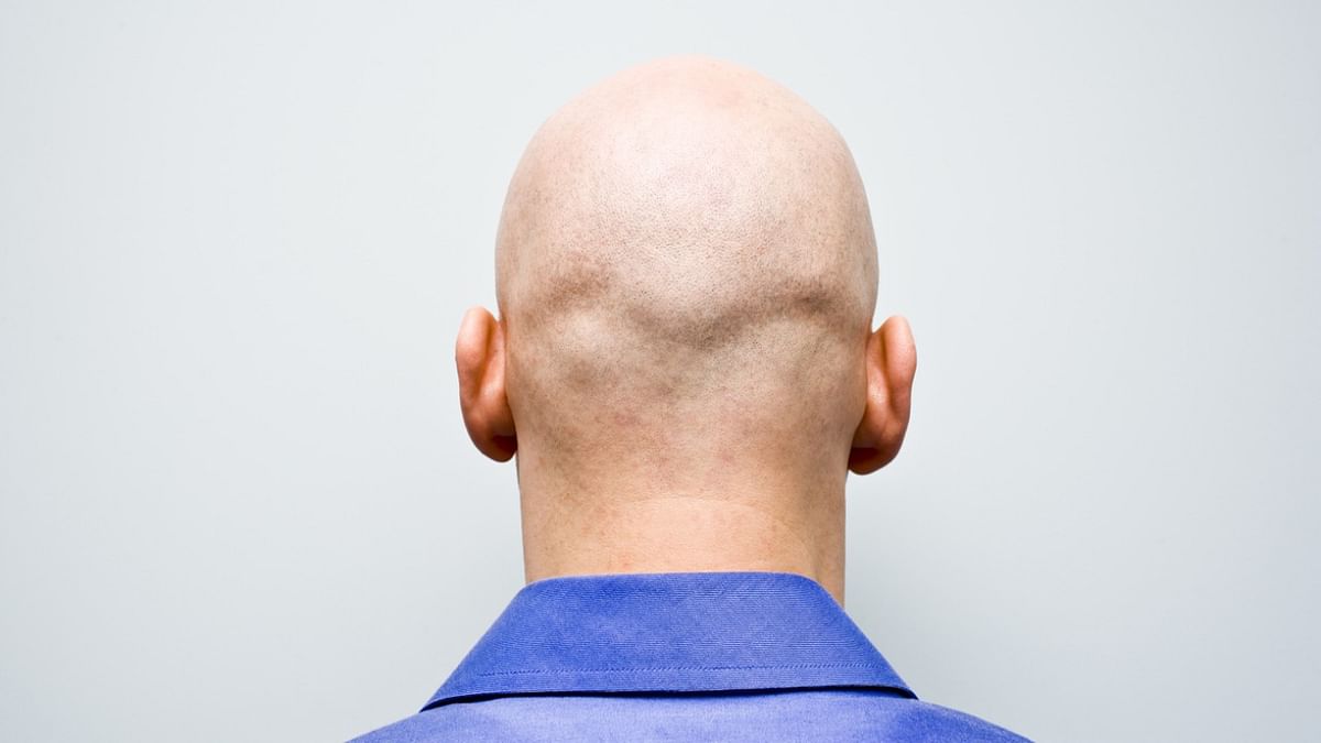 Calling men ‘bald’ counts as sexual harassment, UK tribunal rules