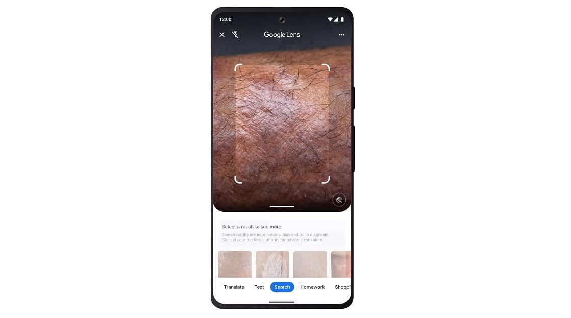 Google Lens gets new feature to help identify skin conditions