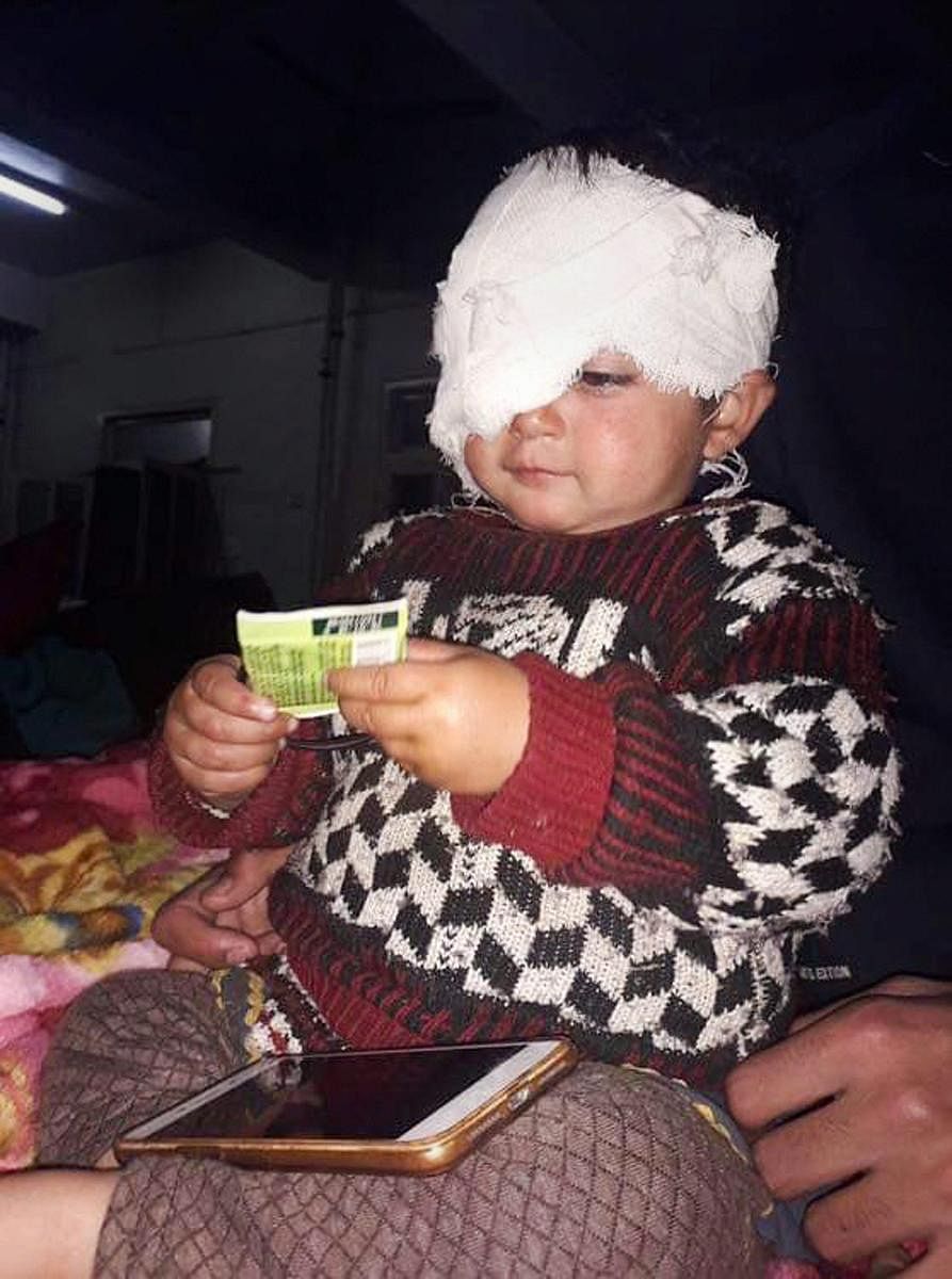 Srinagar: 19-month old Hiba Nisar, the youngest pellet victim undergoes treatment after surgery in her right eye at SMHS Hospital, in Srinagar, Tuesday, Nov.27, 2018. (PTI Photo)