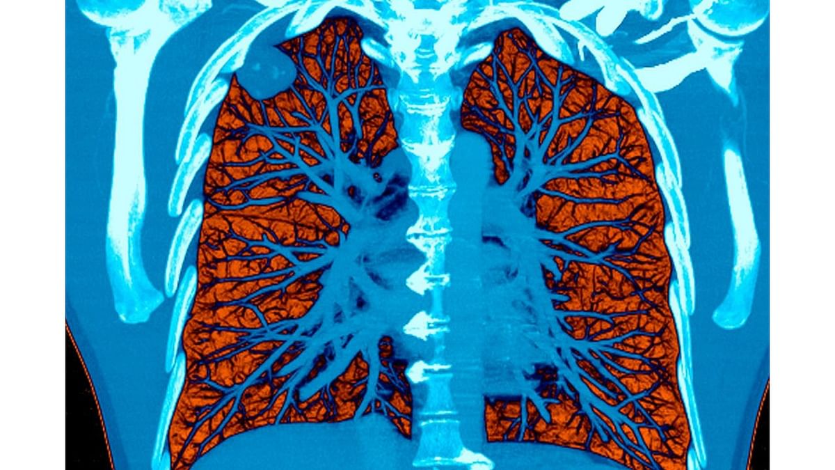 One is easy to catch lung cancer due to the uncontrolled division of cells present within the lungs that gets easily affected by toxic air. DH Pool Photo