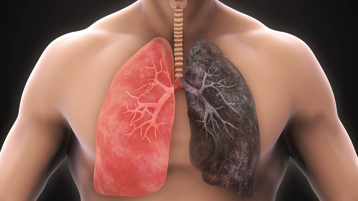 Long exposure to PM and nitrogen oxide may lead to chronic bronchitis. Credit: Getty Images