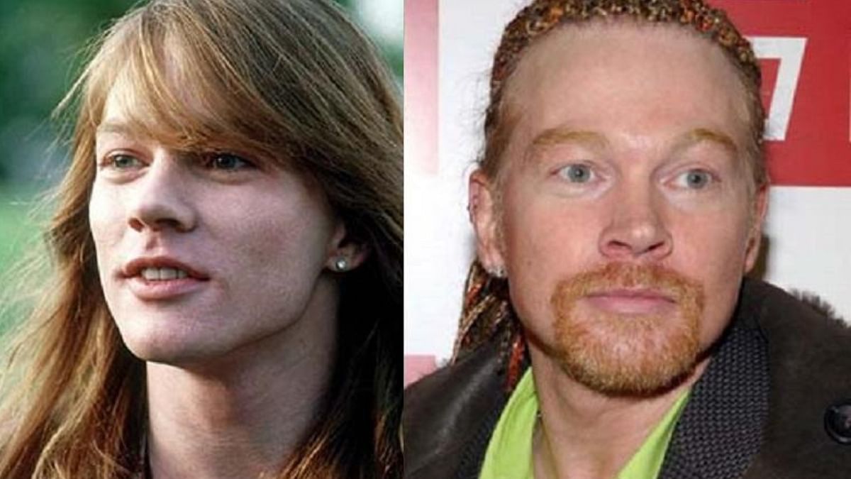 Guns N' Roses' frontman Axl Rose got cheek implants and a facelift done to look younger. Later, it was that he was not pleased with the procedure results. Credit: Special Arrangement