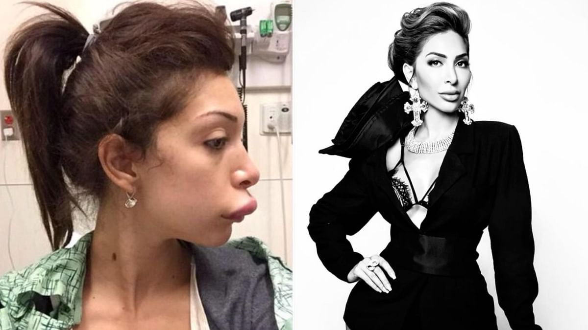 American TV personality Farrah Abraham opened up about her lip surgery that got messed up and posted a photo on social media showing what happens when lip enhancements go wrong. Farrah has reportedly spent millions on cosmetic procedures to look as great as ever. Credit: Instagram/farrahabraham