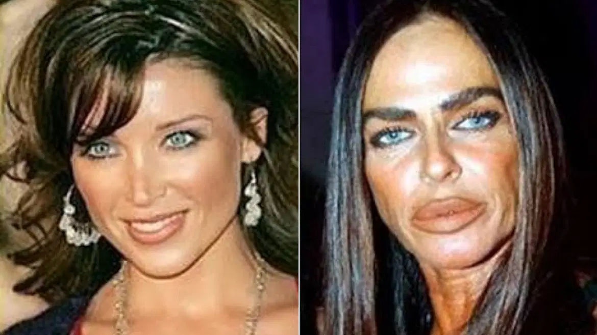 Michaela Romanini, who was once considered one of Italy's most beautiful faces, suffered a plastic surgery disaster that made her face incomparable to the one she possessed in her youth. Credit: Instagram/postedxtagged