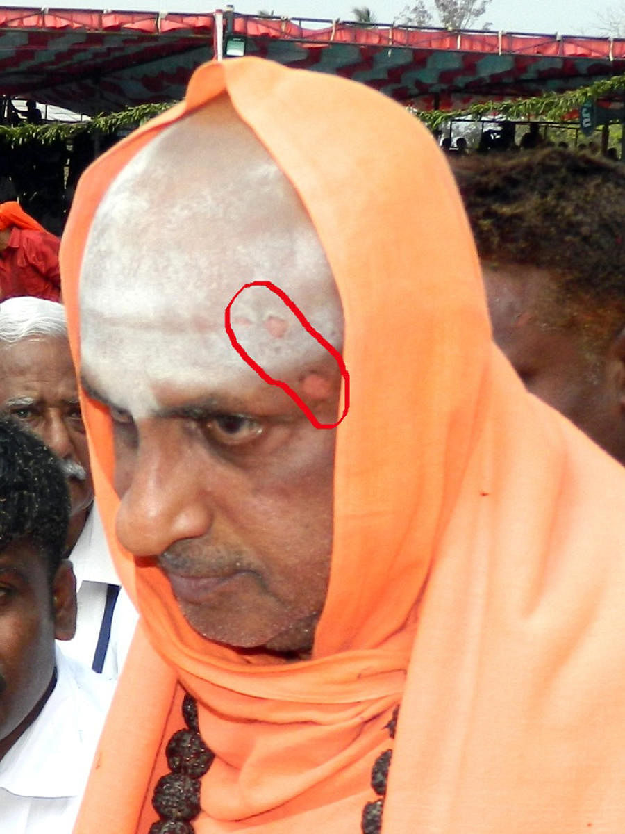 Minor burn injuries near the eye of Suttur seer Shivaratri Deshikendra Swami.