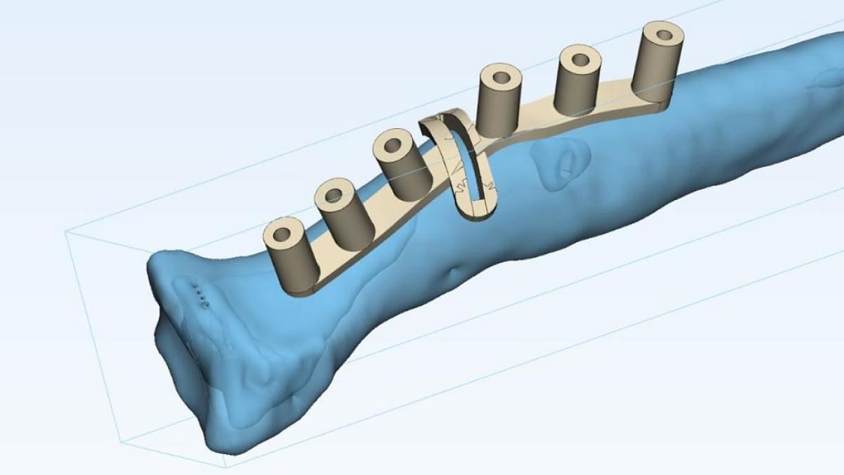A virtual three-dimensional image of a deformed upper limb on special software being used by doctors at SGITO to find a solution to fix the problem.