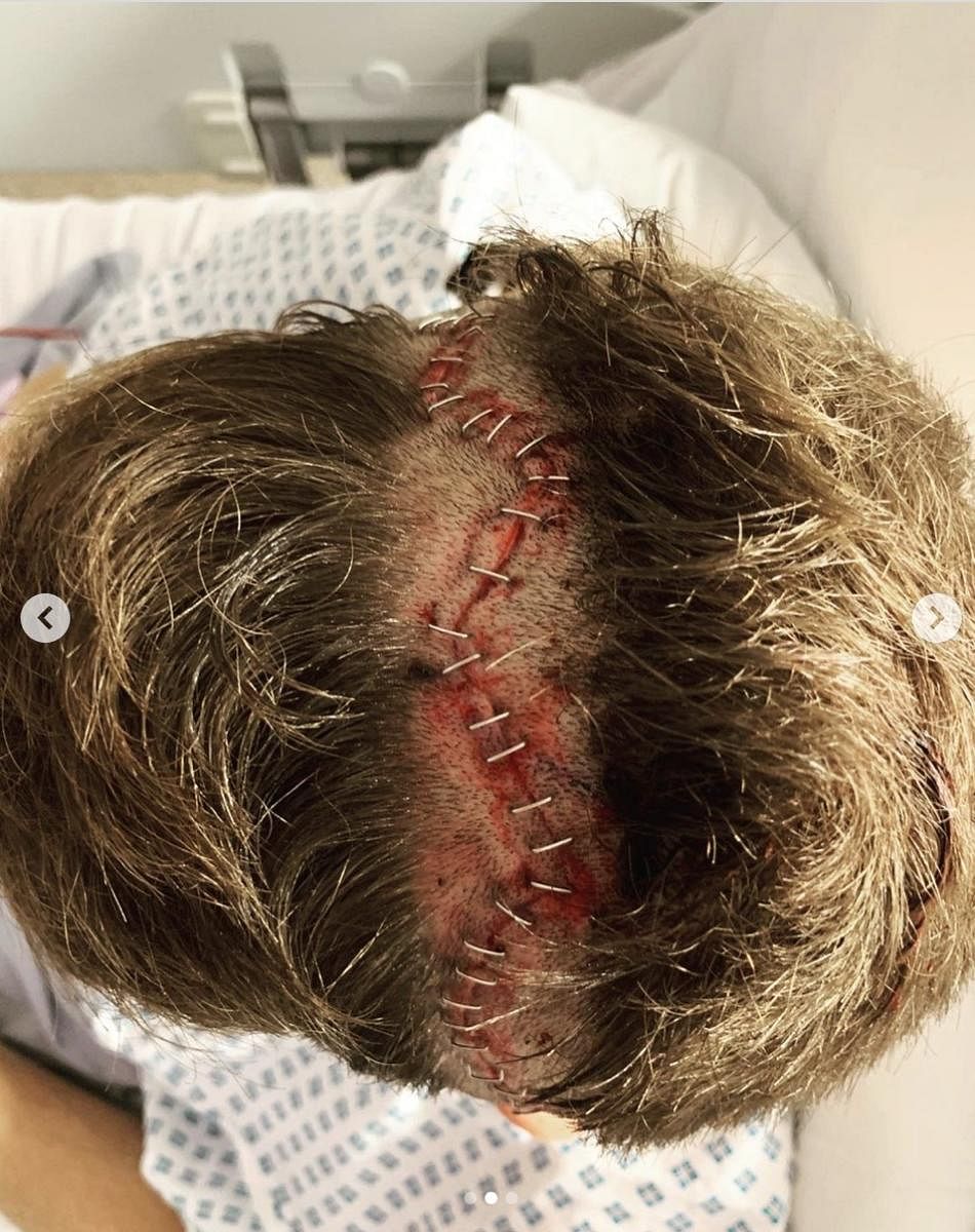 The images show the staples on Sam Ward's head that the England forward had to go through after being hit by a speeding ball during an Olympic Qualifier game against Malaysia. Credit: Instagram