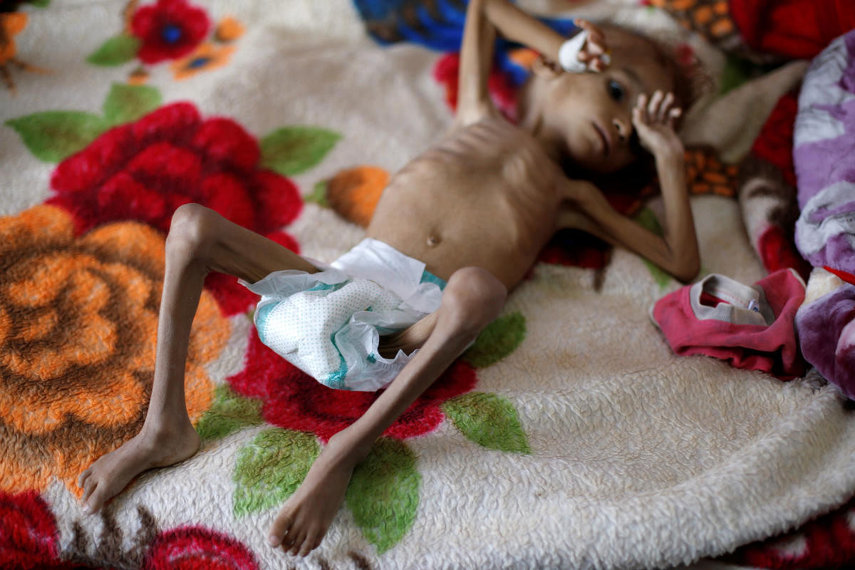 A malnourished boy lies on a bed in a malnutrition treatment centre at the al-Sabeen hospital in Sanaa, Yemen October 6, 2018. REUTERS/Khaled Abdullah