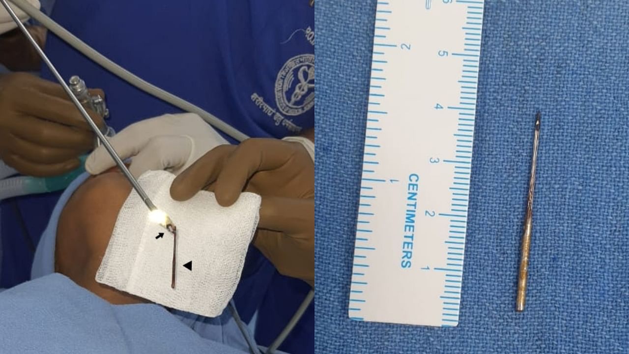 <div class="paragraphs"><p>Applying the out-of-the box solution, they took out the four cm long needle within 15 minutes even though only a few mm of the needle was visible in the endoscopy. Most of it was embedded deep inside the lung.</p></div>