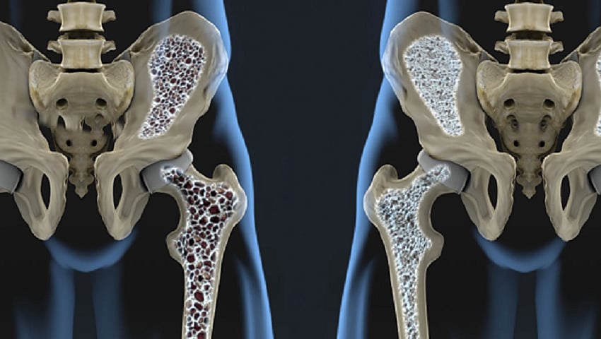 Osteoporosis Reviews Symptoms, Causes and Treatment