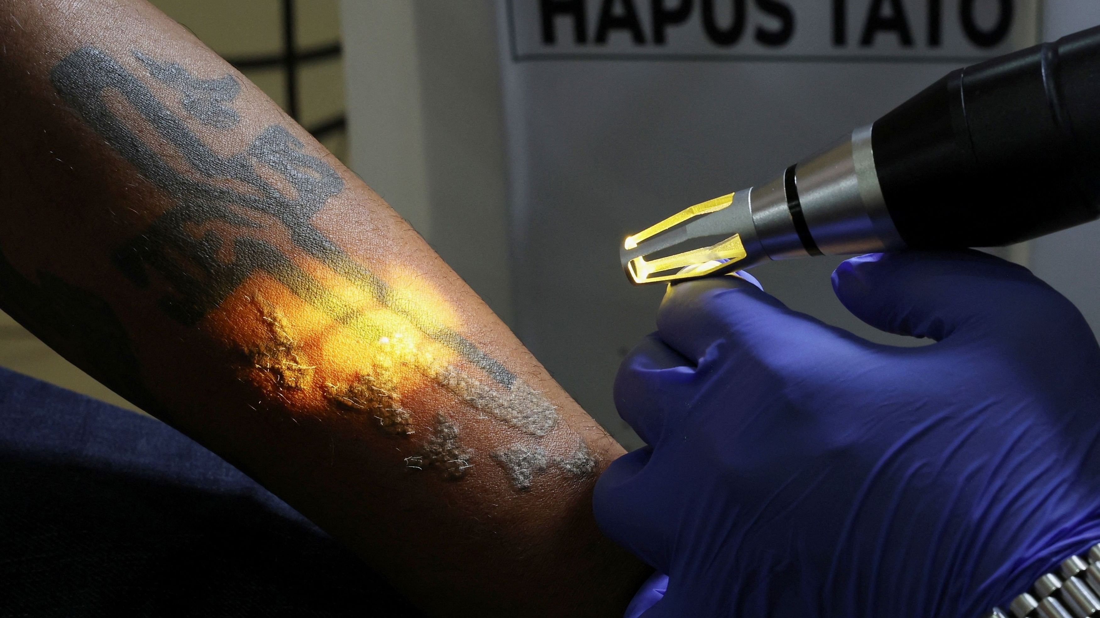 <div class="paragraphs"><p>Representative image of tattoo removal with a laser.</p></div>
