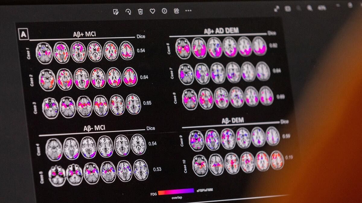 <div class="paragraphs"><p>A scientist looks at hypometabolic and hypoperfusion patterns at the single-subject level from a patient suffering from Alzheimer's disease at the Memory Centre at the Department of Readaptation and Geriatrics of the University Hospital (HUG), in Geneva, Switzerland.</p></div>