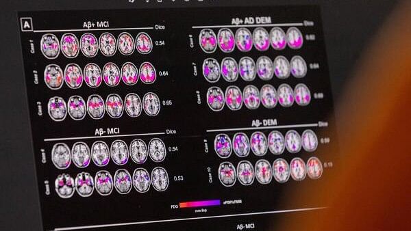 <div class="paragraphs"><p>Hypometabolic and hypoperfusion patterns at the single-subject level from a patient suffering from Alzheimer's.</p></div>