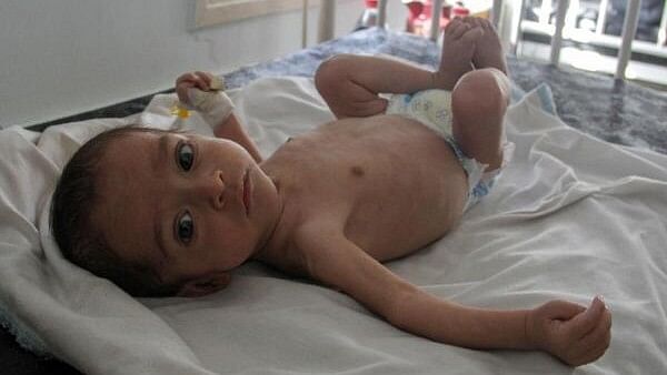 <div class="paragraphs"><p>Majd Salem, a six-month-old malnourished Palestinian baby who weighed 3.5 kg when he was born and gained just 300 grams in six months, lies on a bed as he receives treatment at Kamal Adwan hospital in the northern Gaza Strip May 9, 2024.</p></div>