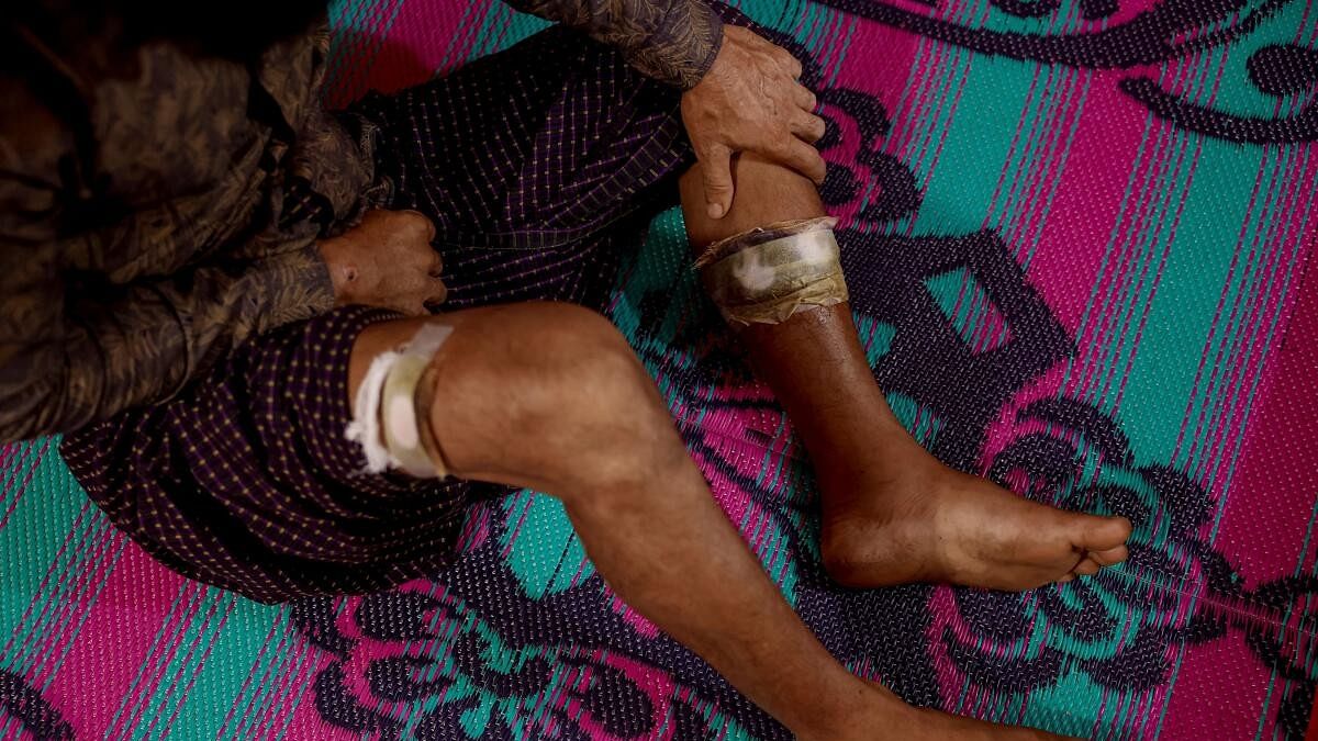 <div class="paragraphs"><p>A Rohingya Muslim man who fled to Bangladesh from Maungdaw township of Myanmar after being injured in a drone attack</p></div>