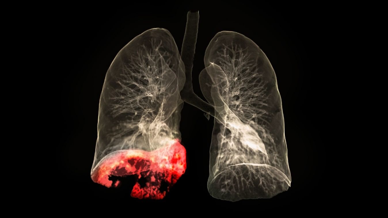 <div class="paragraphs"><p>Representative image of lung cancer.</p></div>