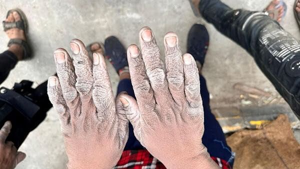 <div class="paragraphs"><p>A child who was found illegally working in a distillery shows their hands, which the National Commission for Protection of Child Rights (NCPCR) said were burnt due to contact with chemicals, in this picture obtained from social media.</p></div>