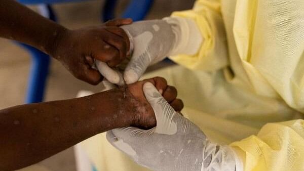 <div class="paragraphs"><p>Christian Musema, a laboratory nurse, takes a sample from a child declared a suspected case of mpox at the treatment centre in Munigi, following mpox cases in Nyiragongo territory near Goma, North Kivu province, Democratic Republic of the Congo on July 19, 2024. </p></div>