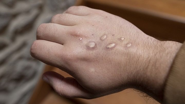 <div class="paragraphs"><p>Representative image of mpox rashes.</p></div>