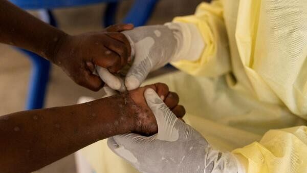 <div class="paragraphs"><p>Christian Musema, a laboratory nurse, takes a sample from a child declared a suspected case of Mpox at the treatment centre in Munigi, following Mpox cases in Nyiragongo territory near Goma, North Kivu province, Democratic Republic of the Congo.&nbsp;</p></div>