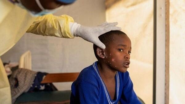 <div class="paragraphs"><p>Dr. Tresor Wakilongo, verifies the evolution of skin lesions on the ear of Innocent, suffering from Mpox - an infectious disease caused by the monkeypox virus that sparks off a painful rash, enlarged lymph nodes and fever; at the treatment centre in Munigi, following Mpox cases in Nyiragongo territory near Goma, North Kivu province, Democratic Republic of Congo.</p></div>