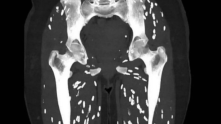 <div class="paragraphs"><p>Cysticercosis is an infamous parasitic infection caused by ingestion of larval cysts of Taenia Solium, also known as: Pork Tapeworm.&nbsp;</p></div>