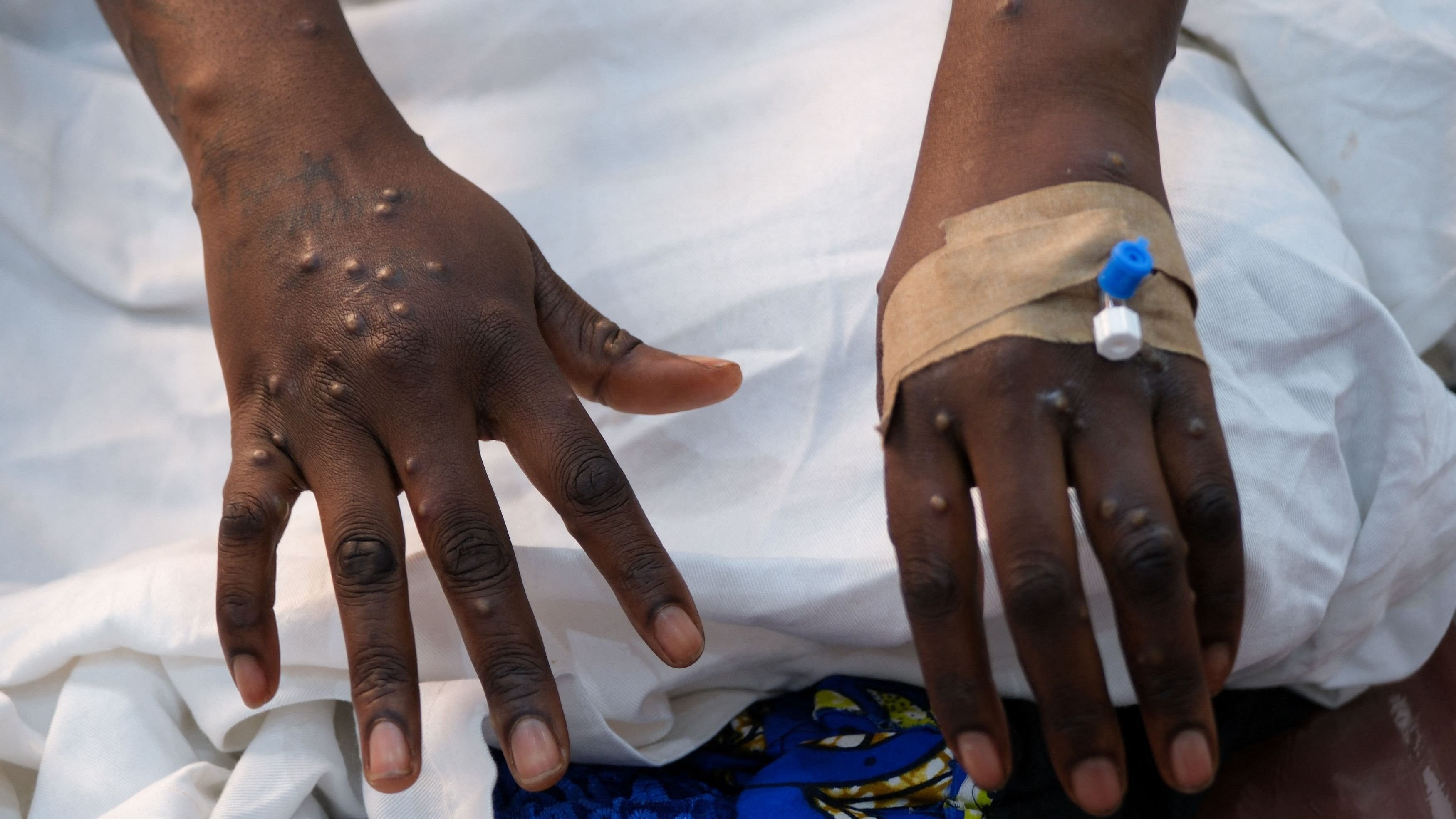 <div class="paragraphs"><p>The hands of a patient with skin rashes caused by the mpox virus are pictured.</p></div>