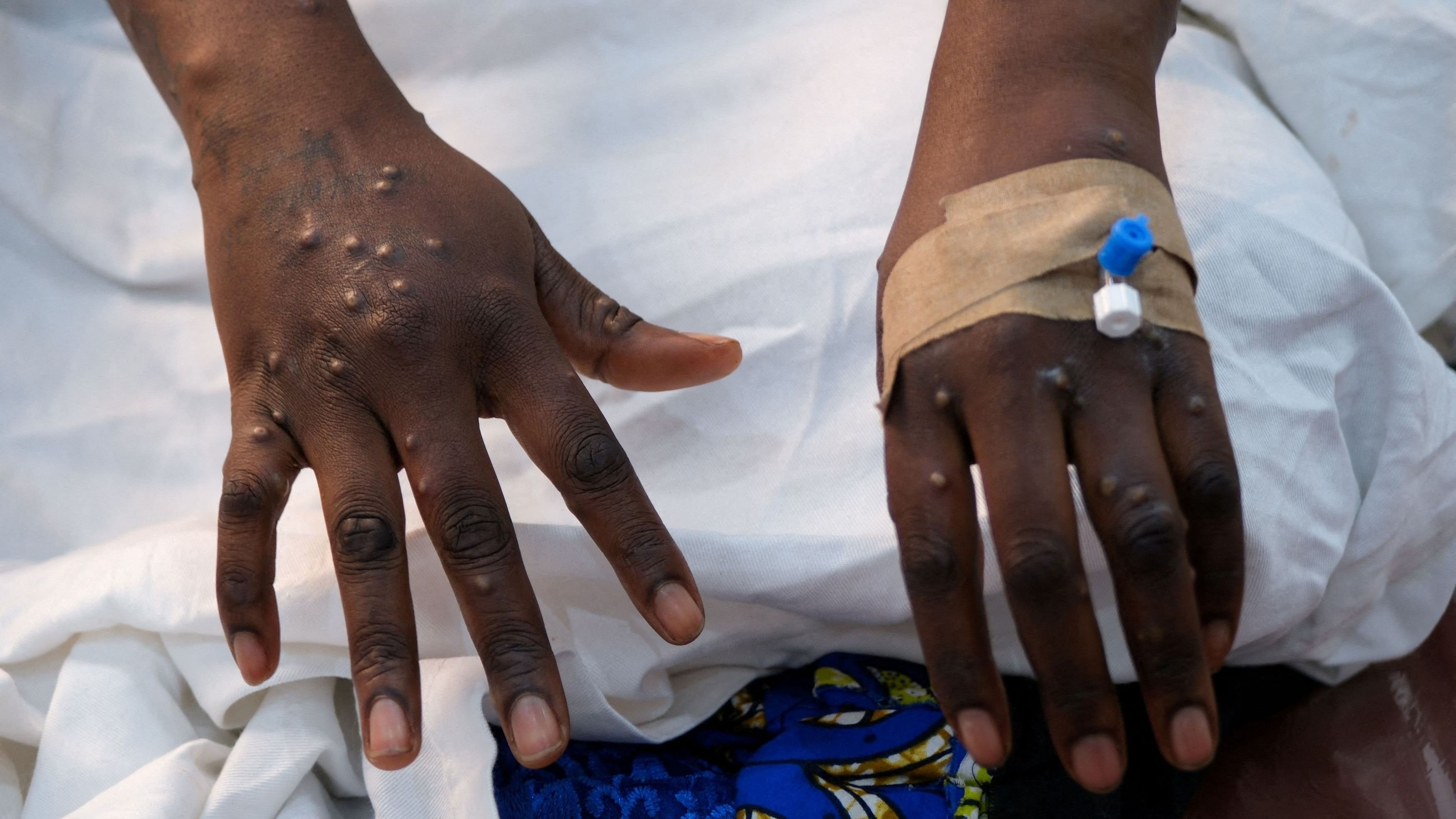 <div class="paragraphs"><p>The hands of a patient with skin rashes caused by the mpox virus.</p></div>