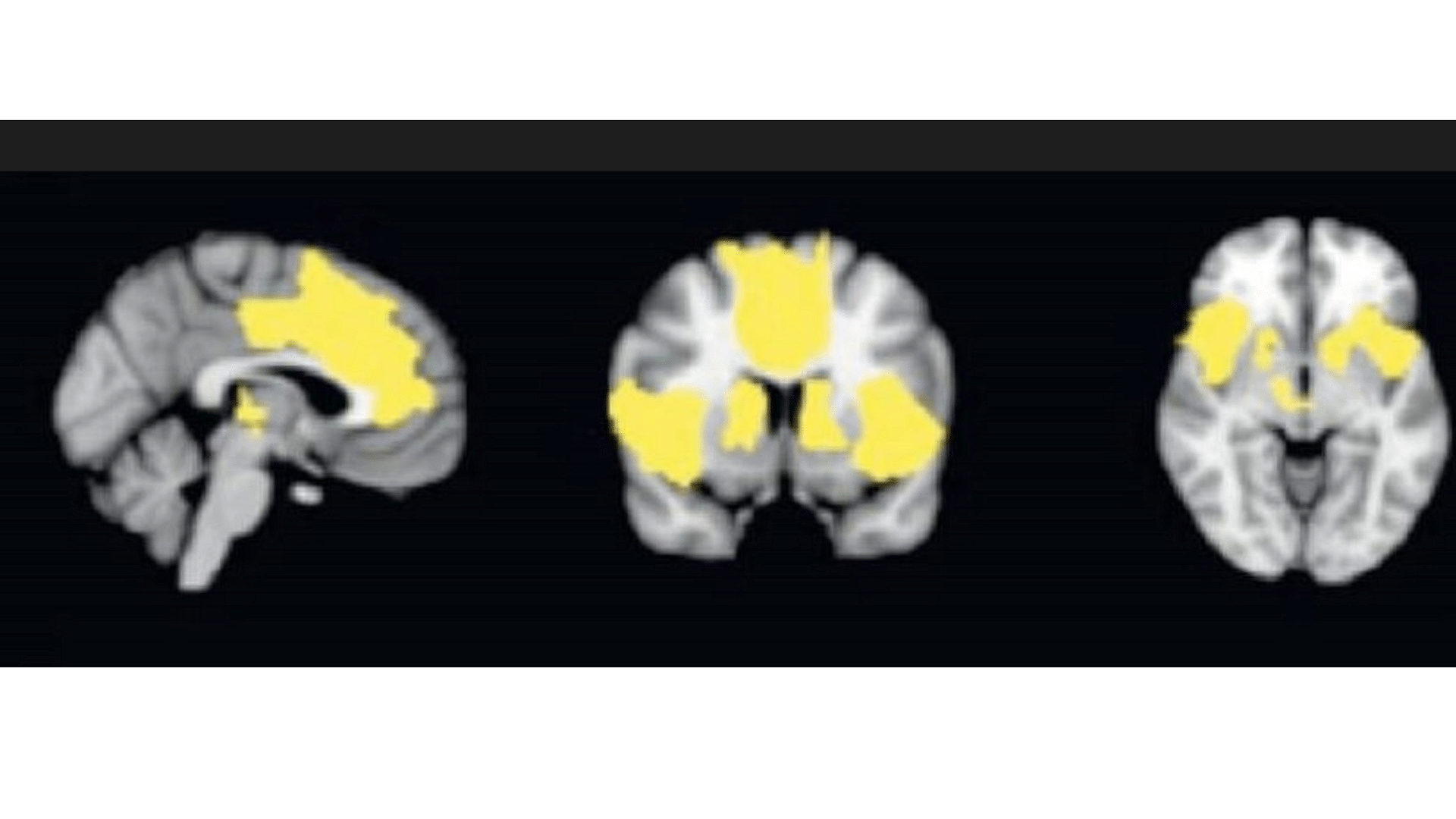 <div class="paragraphs"><p>Depression leaves its imprint on the brain</p></div>