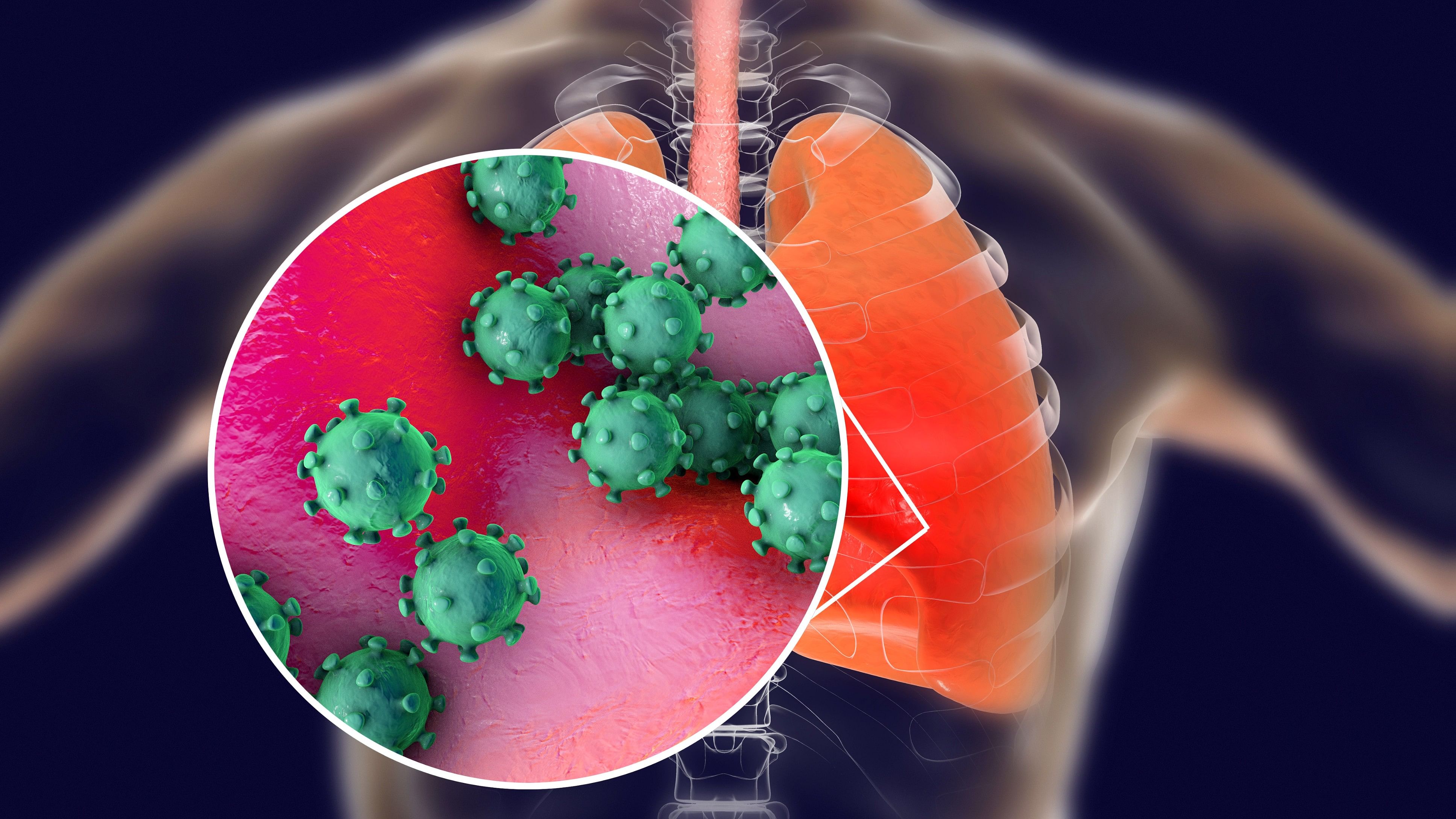 <div class="paragraphs"><p>Representative image of a condition in the lungs.</p></div>