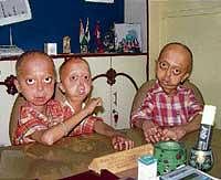 Family battles with rare progeria disease